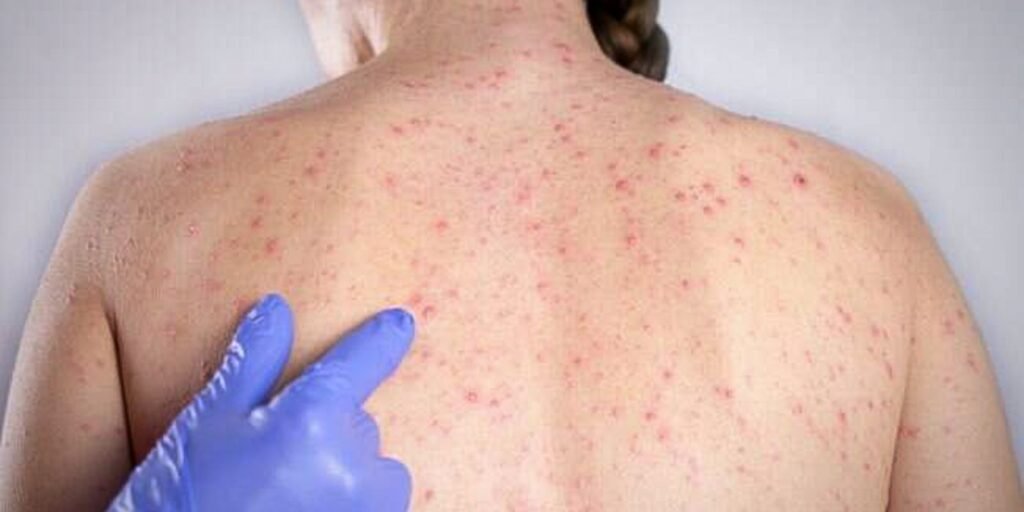 Casos de sarampo sobem para 16 e reforçam alerta de vacinação