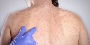 Casos de sarampo sobem para 16 e reforçam alerta de vacinação