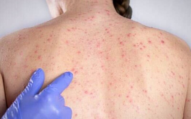 Casos de sarampo sobem para 16 e reforçam alerta de vacinação