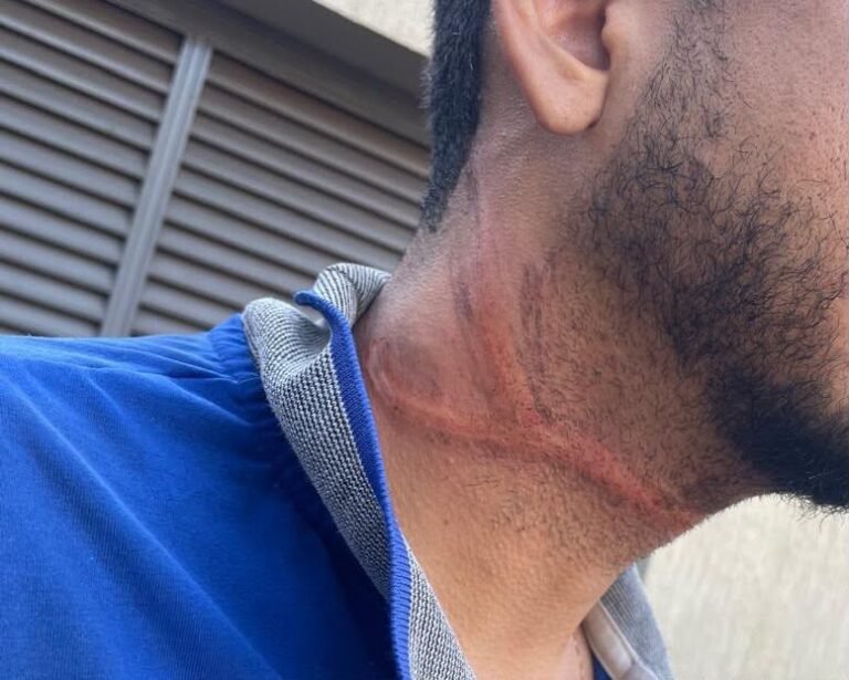 Motociclista fica ferido após cabo caído em Ituiutaba
